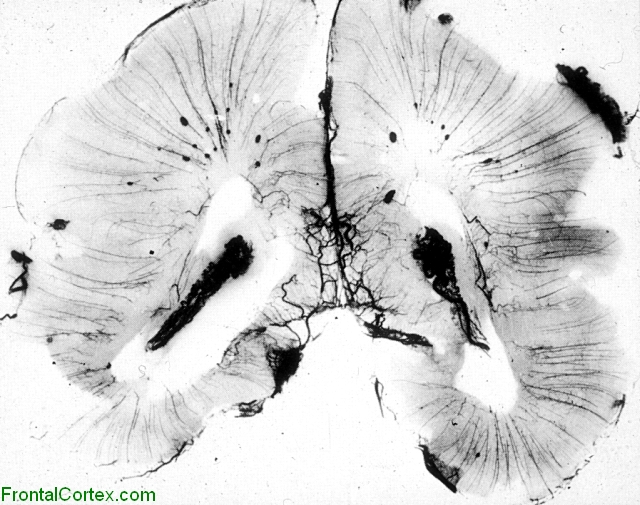 Neonatal brain, micro-injection of cerebral circulation